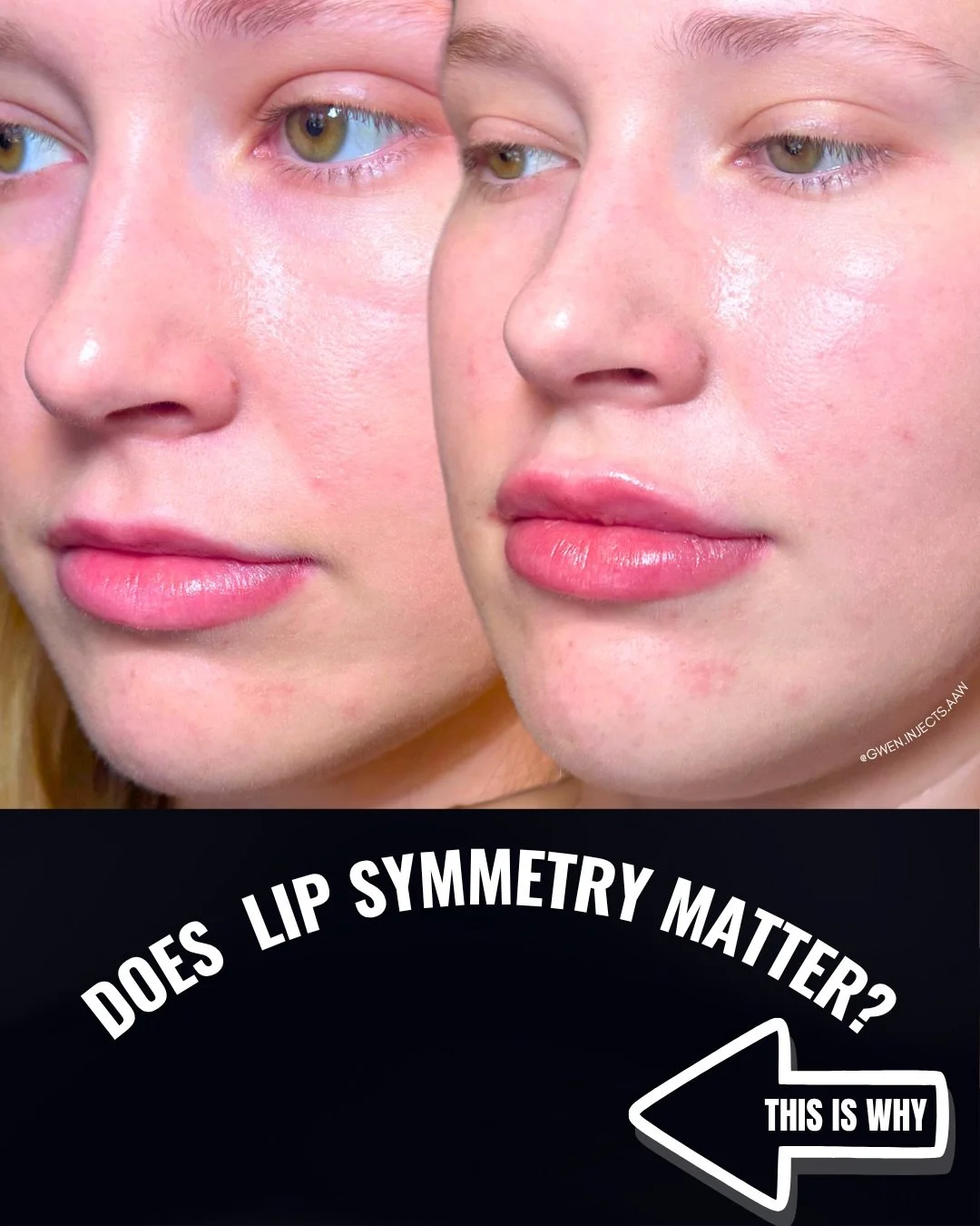 &zwnj; Lip symmetry plays a critical role in overall facial balance. When the lower lip is disproportionately fuller than the upper, it can create a bottom-heavy appearance.

In this case, targeted HA filler was used to enhance the upper lip and rest