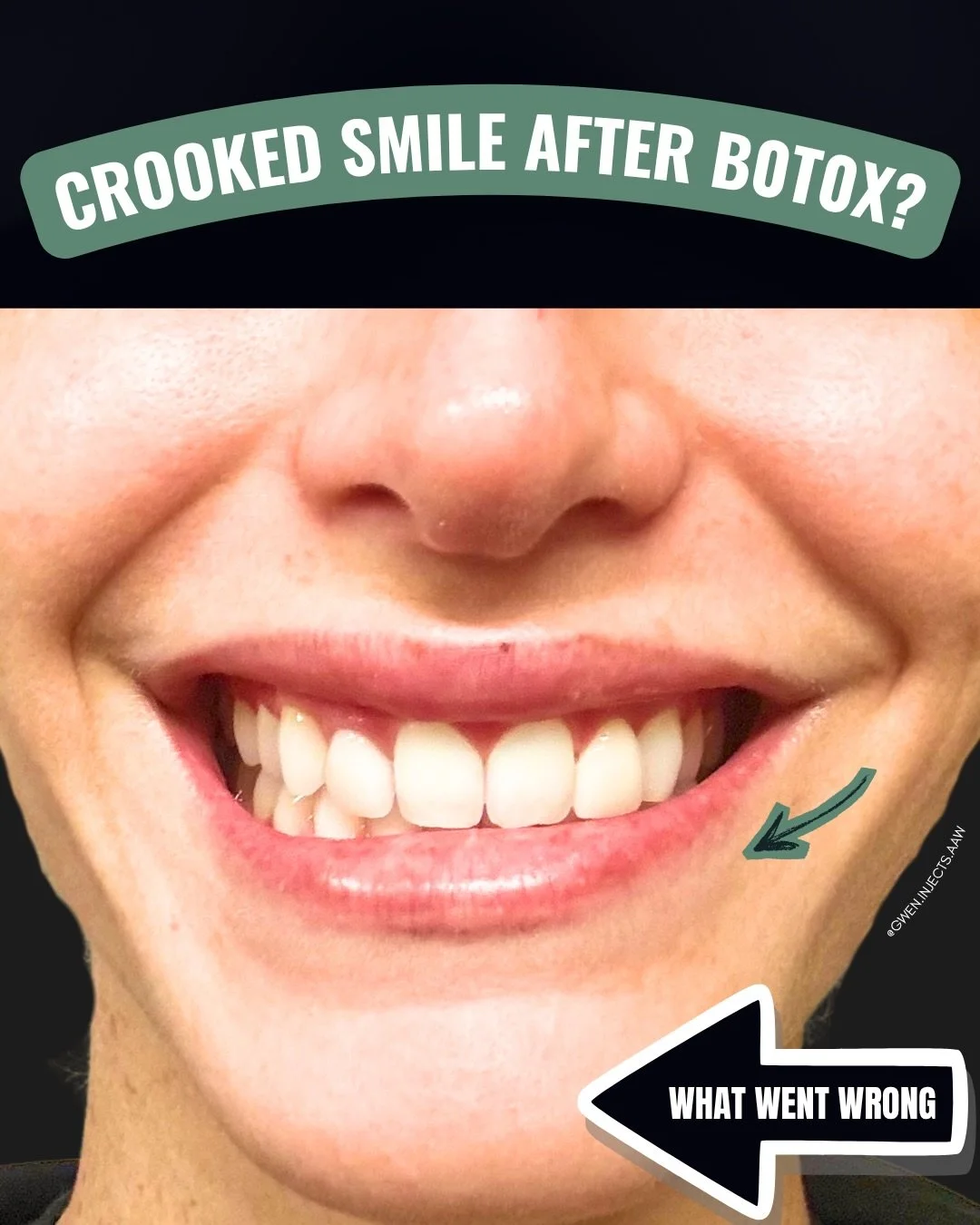 Why does my smile look&hellip; off after B0t0x?&rdquo; 

If you&rsquo;ve noticed a crooked or uneven smile, here&rsquo;s what might be going on:

When treating the lower face, we&rsquo;re often targeting the DAO (depressor anguli oris) and mentalis t