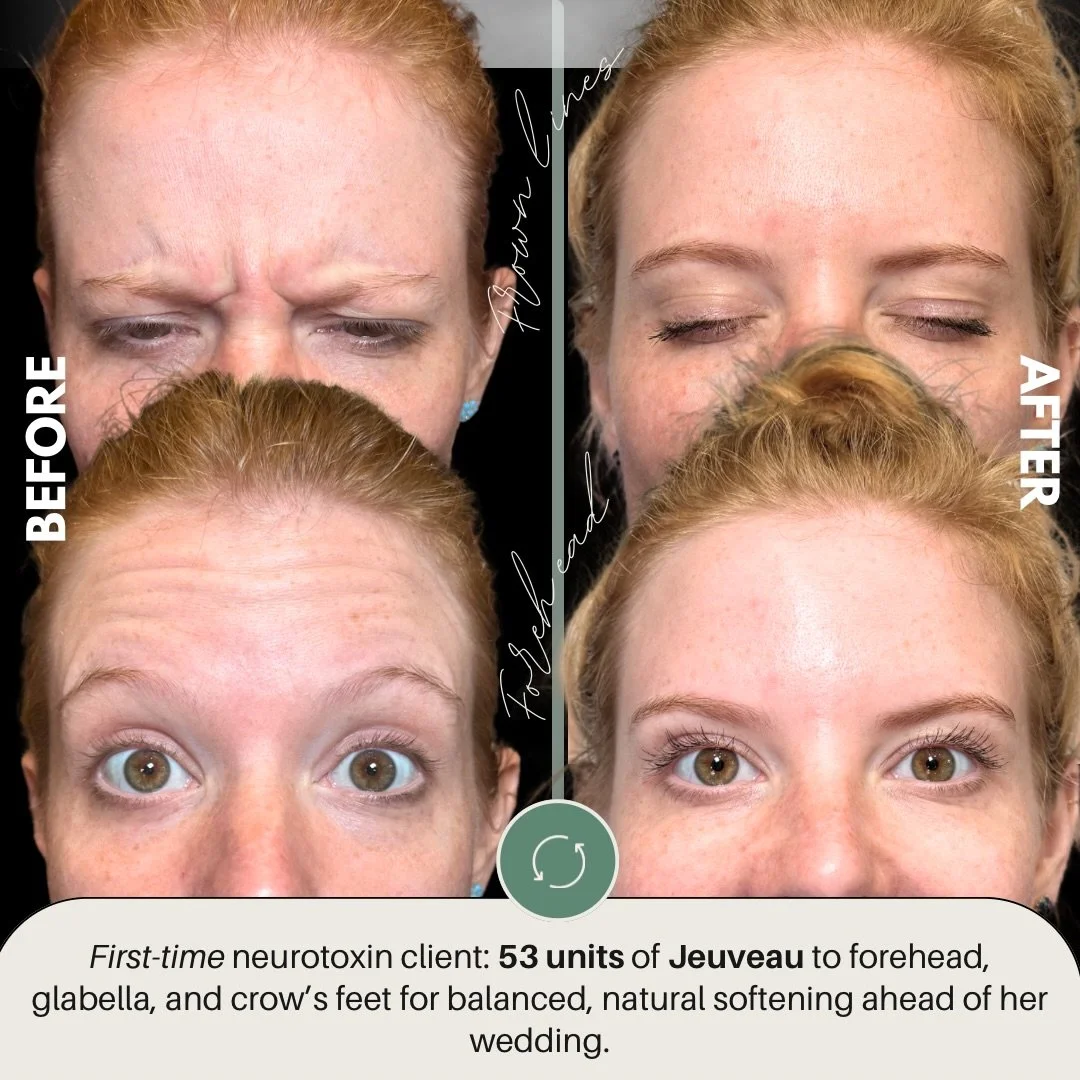 First-time tox for our bride-to-be 💍 with @jeuveaubyevolus 
-
-
-
👩🏻&zwj;⚕️Gwen Alonso, APRN
📍2915 N Blvd. Tampa, FL 33602
📱 813-602-7072
📧 info@alonso-aesthetics.com
💻 www.alonso-aesthetics.com