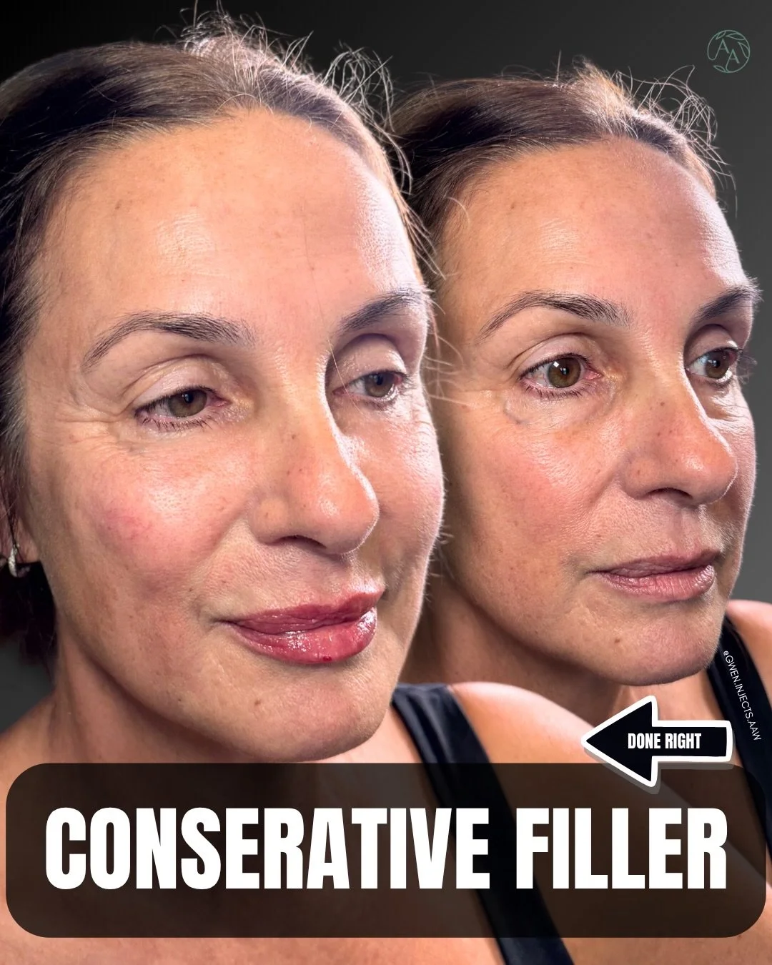 In aesthetics, there&rsquo;s a growing belief that more is better.

More filler.
More volume.
More transformation.

I disagree.

This result is proof that meaningful change doesn&rsquo;t always require six syringes, dramatic volume, or a completely d