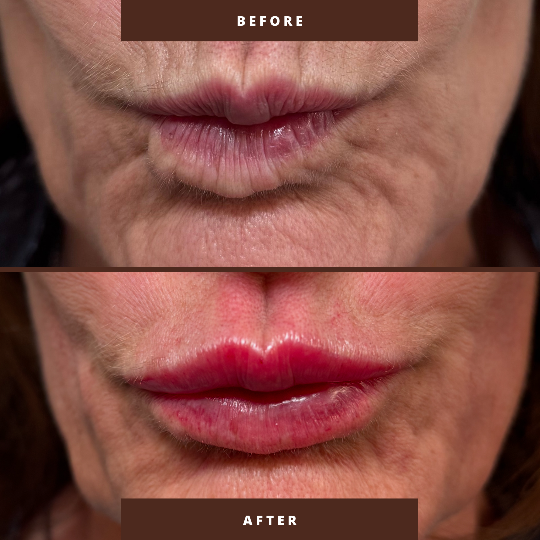 Product: Restylane Kysse & Redensity
Amount: 2.0 mL