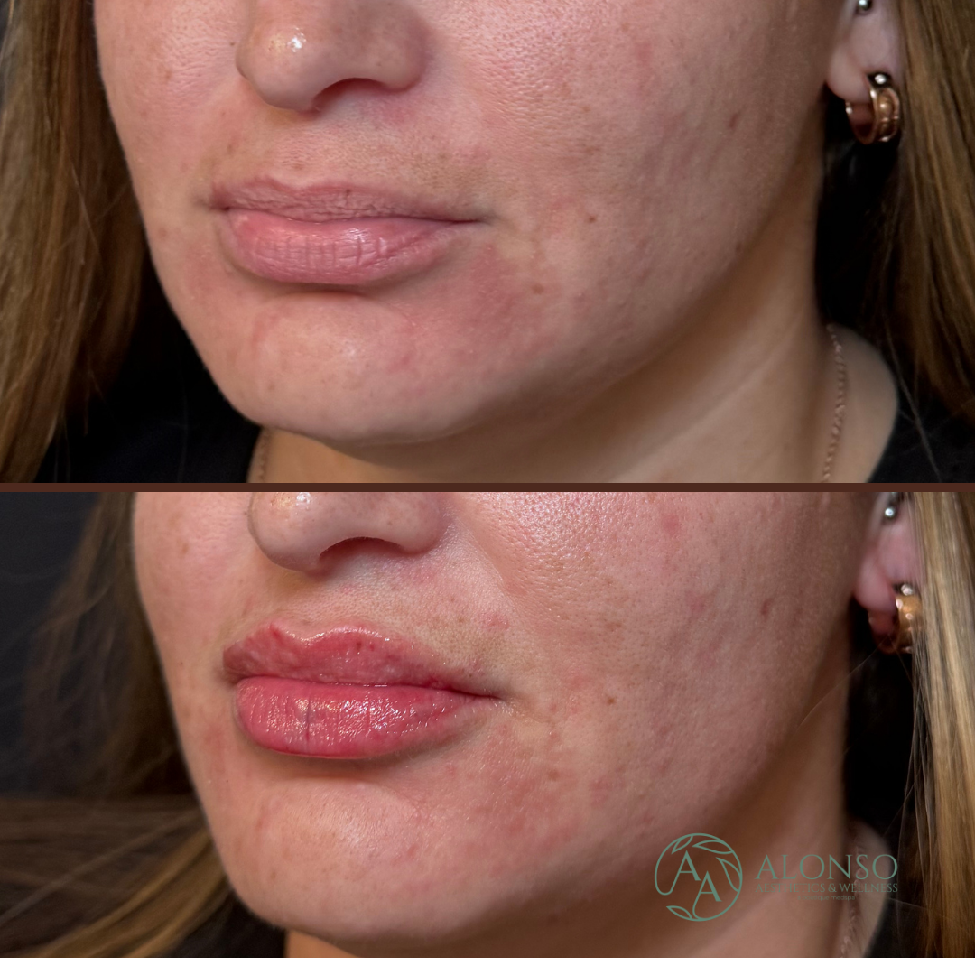 Copy of Copy of Copy of Sculptra B&A.zip - 2.png