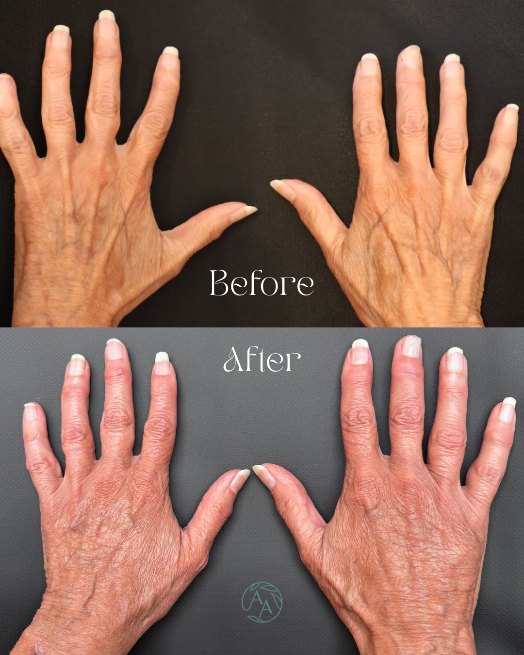 Comparison of hands before and after a treatment or manicure, showing smoother, more moisturized skin and well-maintained nails. The top image labeled 'Before,' shows older, wrinkled hands with dry skin, while the bottom image labeled 'After,' shows younger, more hydrated hands with healthier appearance.