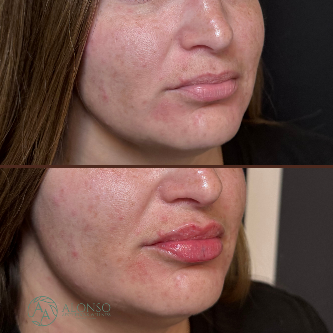 Copy of Copy of Copy of Sculptra B&A.zip - 3.png