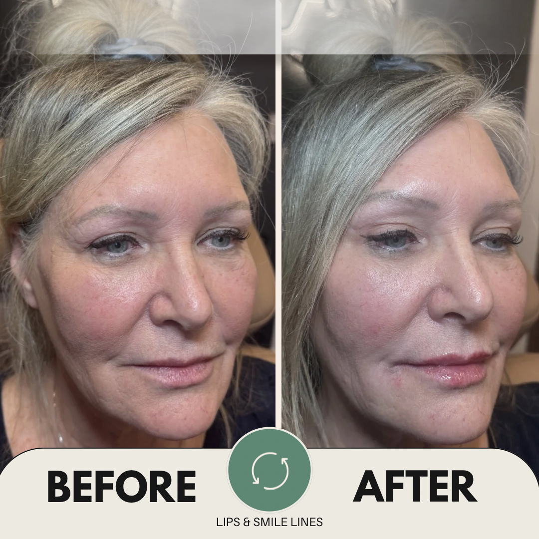 Christine Lips B&A - 3.png