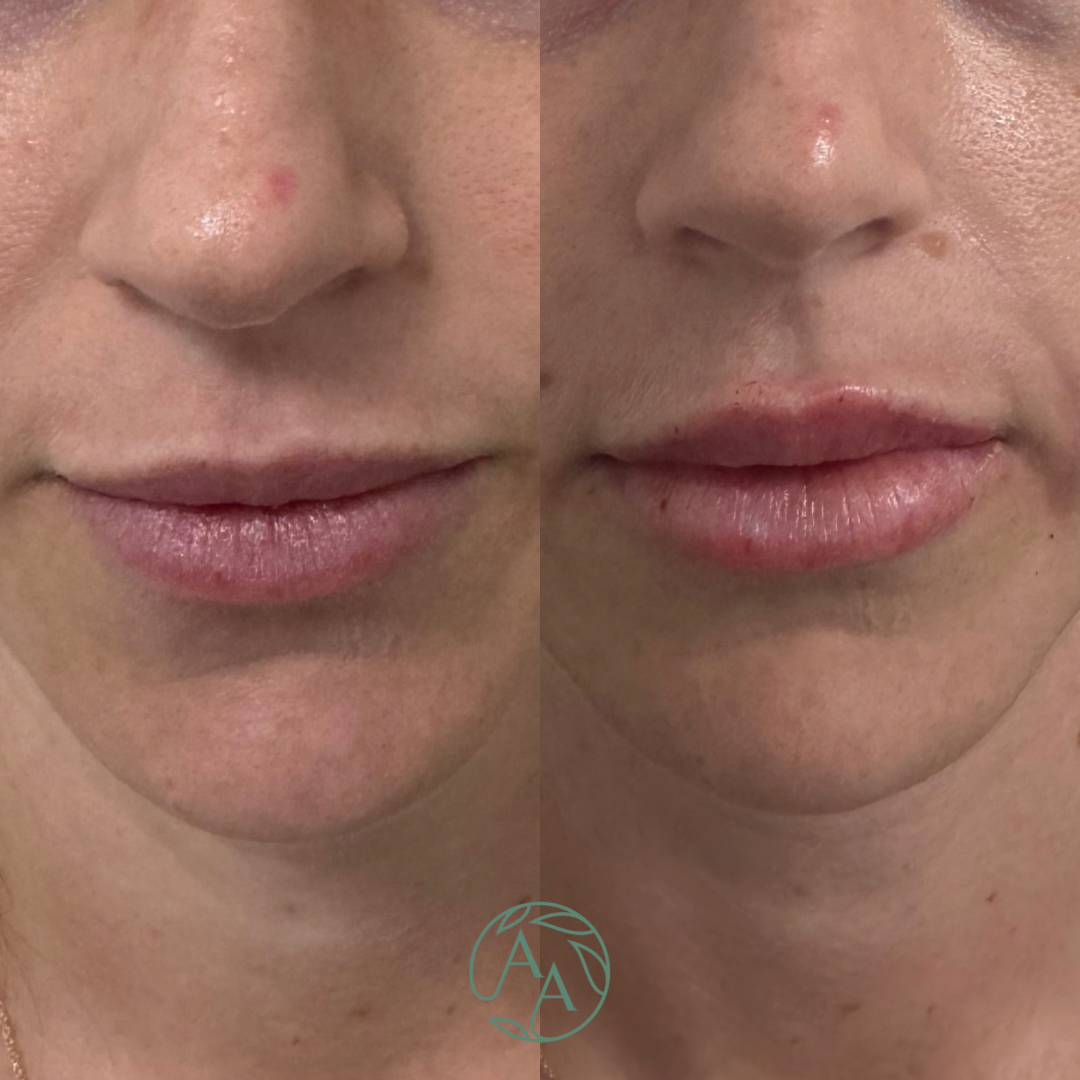 Product: Restylane Kysse
Amount: 1.0 mL