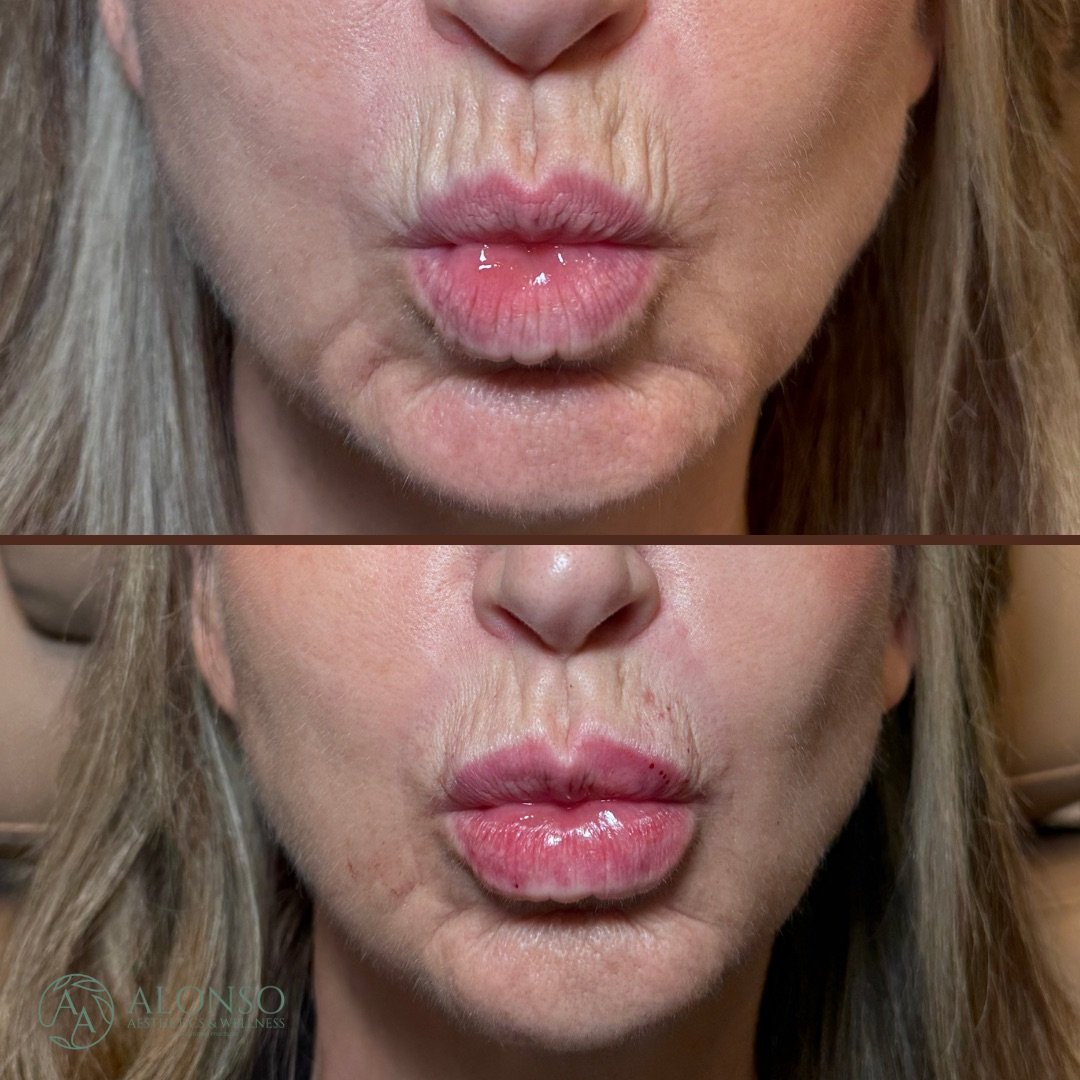 Peri-oral lines 1.0 Redensity