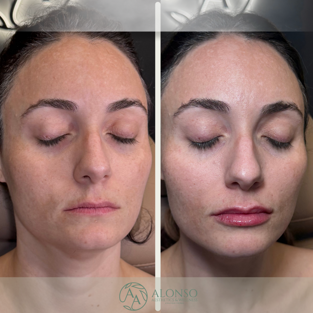 Copy of Copy of Copy of Sculptra B&A.zip - 4.png