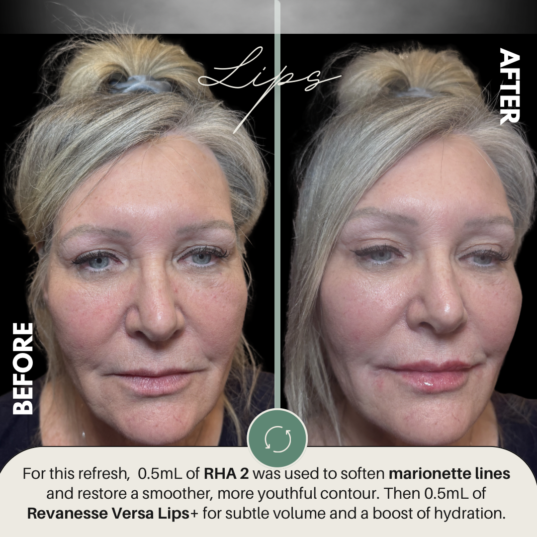 Christine Lips B&A - 1.png