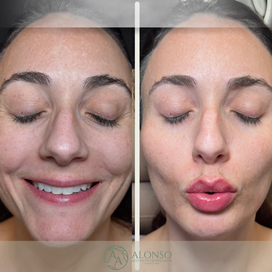 Copy of Copy of Copy of Sculptra B&A.zip - 5.png