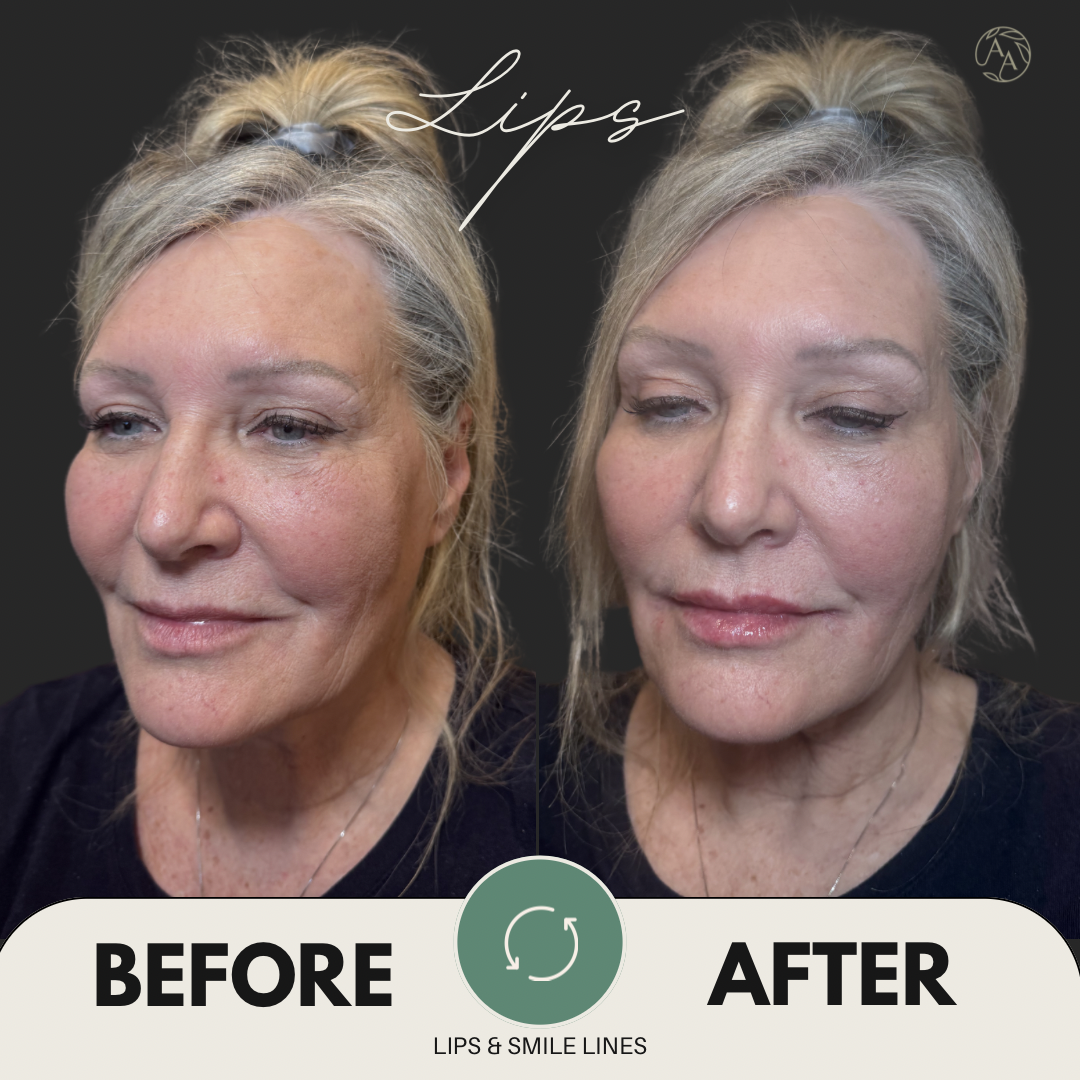 Christine Lips B&A - 2.png