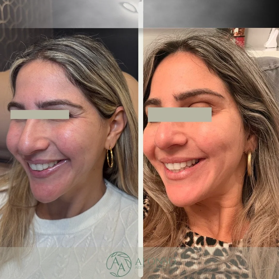BA Botox Meux.zip - 6.png