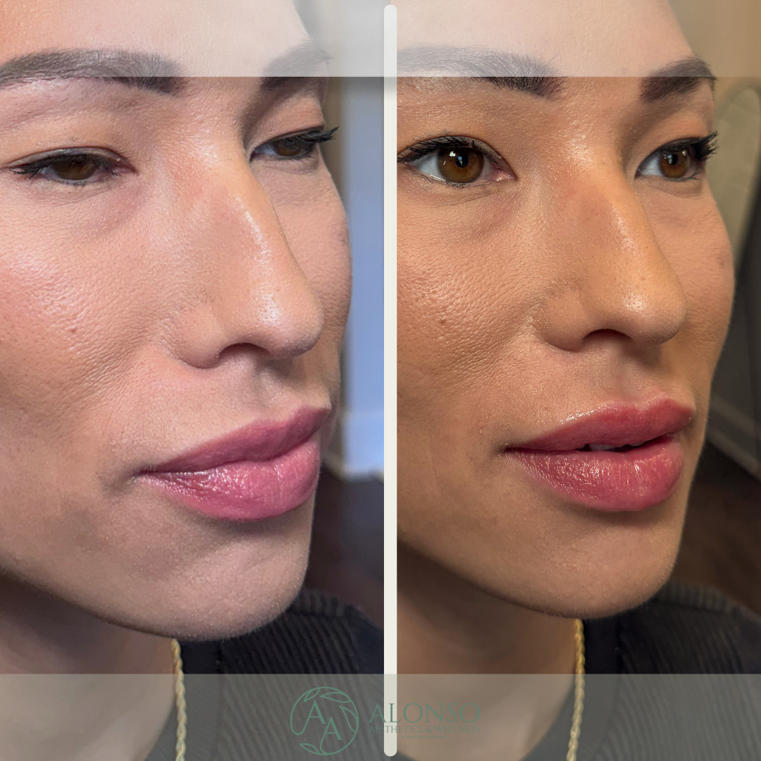 Copy of Copy of B&A Chin & Jawline.zip - 3.png