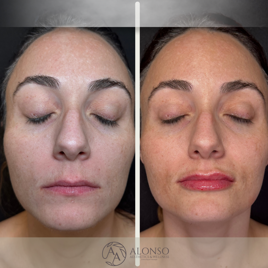 Product: Versa Lips
Amount: 1.0 mL