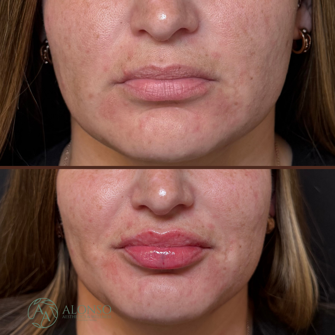 Copy of Copy of Copy of Sculptra B&A.zip - 1.png