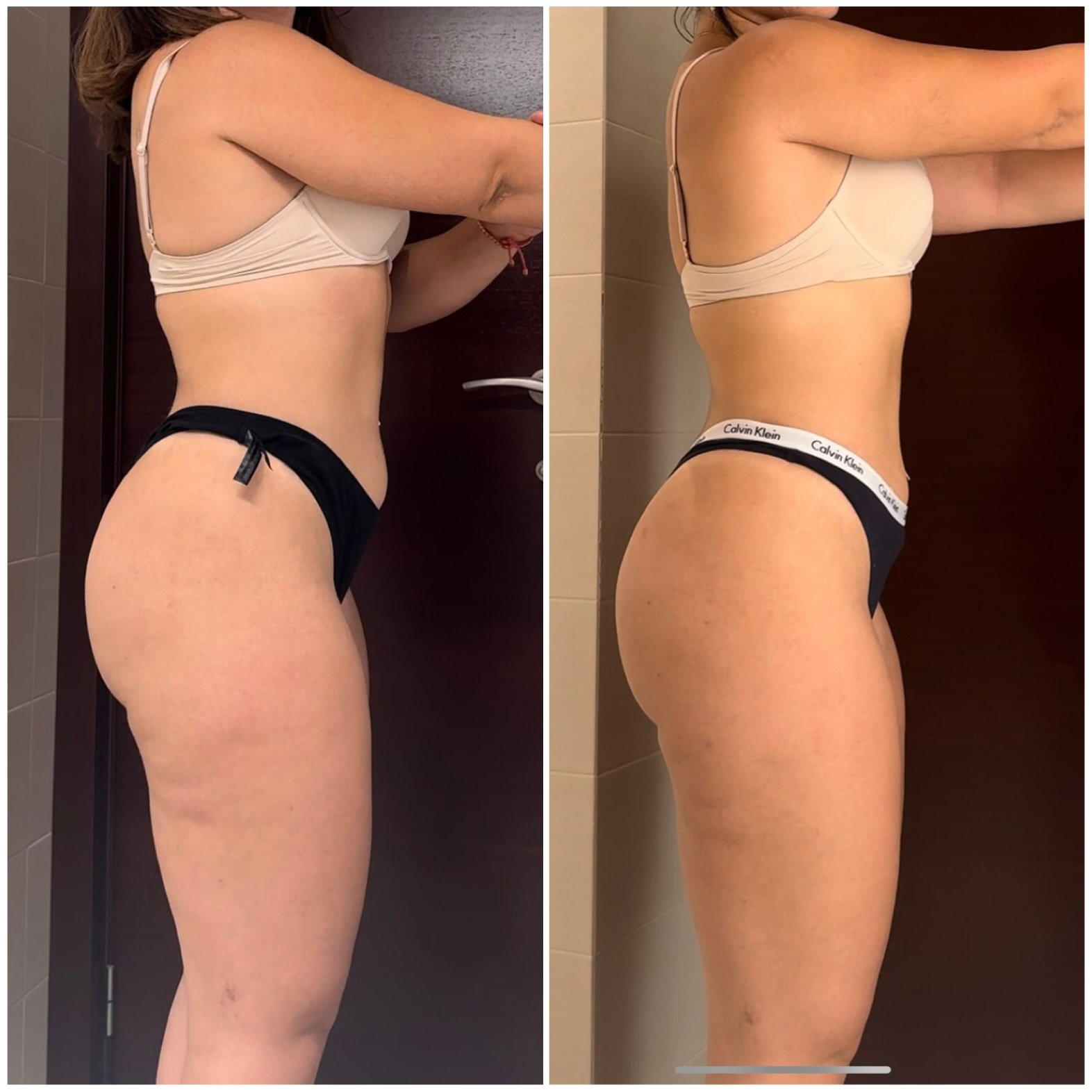 Cambio físico de celulitis en las piernas en 1 mes