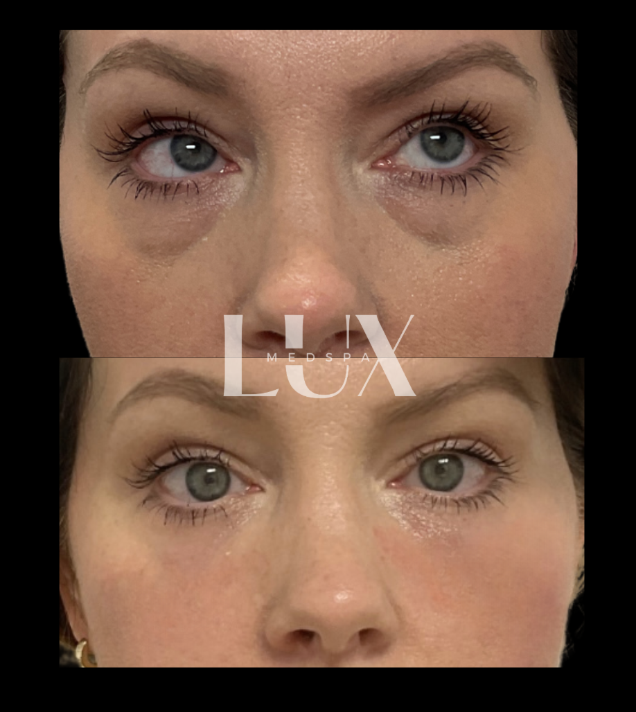 Under Eye Filler - Cellenis Derma PRP Filler