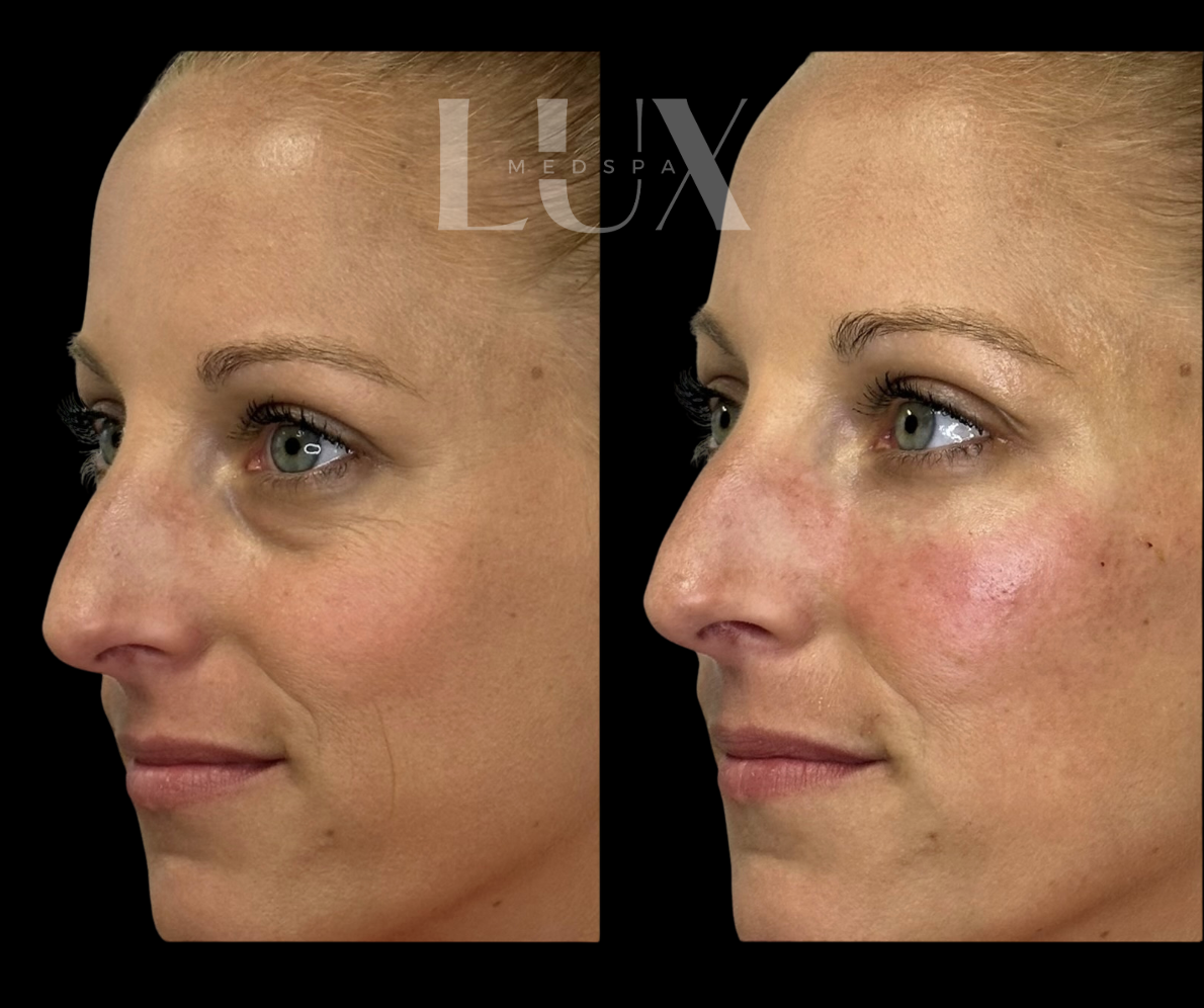 Under Eye Filler - Cellenis Derma PRP Filler