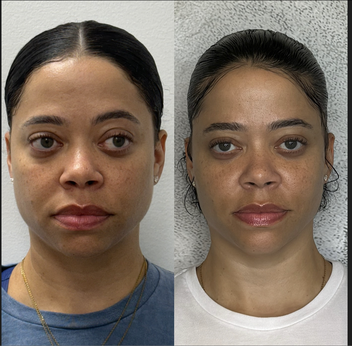 Facial balancing before and after Dallas — full-face proportion treatment at Just Injected Medical Spa.
