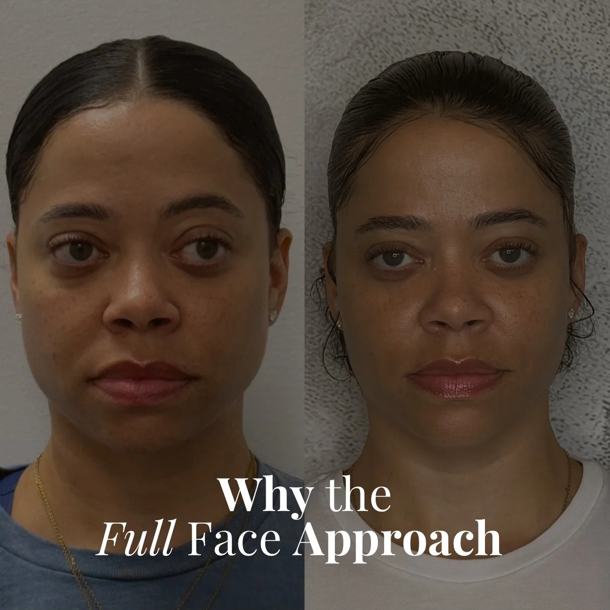 Most people come in asking for one thing, but what they&rsquo;re actually looking for is balance. 🥂🧬

Chasing a single line or a &ldquo;hollow spot&rdquo; usually leads to an overfilled, unnatural look. Looking at the full face results in a more se