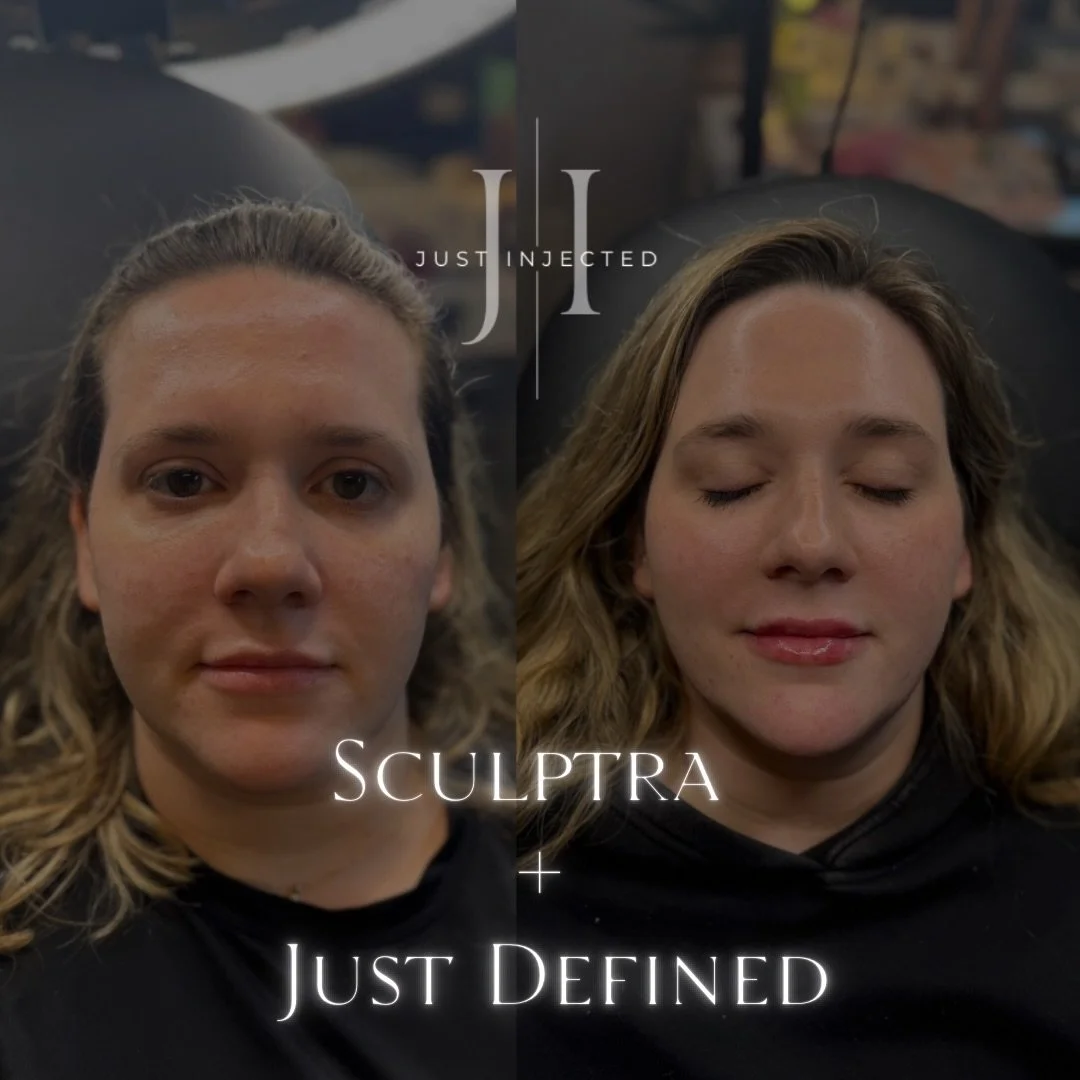 Building results that will last 💉 This is how your Sculptra + Fillers + Tox + Skincare work together ✨

Treatments: 
📐 Sculptra: 1 month post Sculptra to boost that collagen &amp; elastin for tighter more &ldquo;bouncy&rdquo; skin / features 
📐 Dy