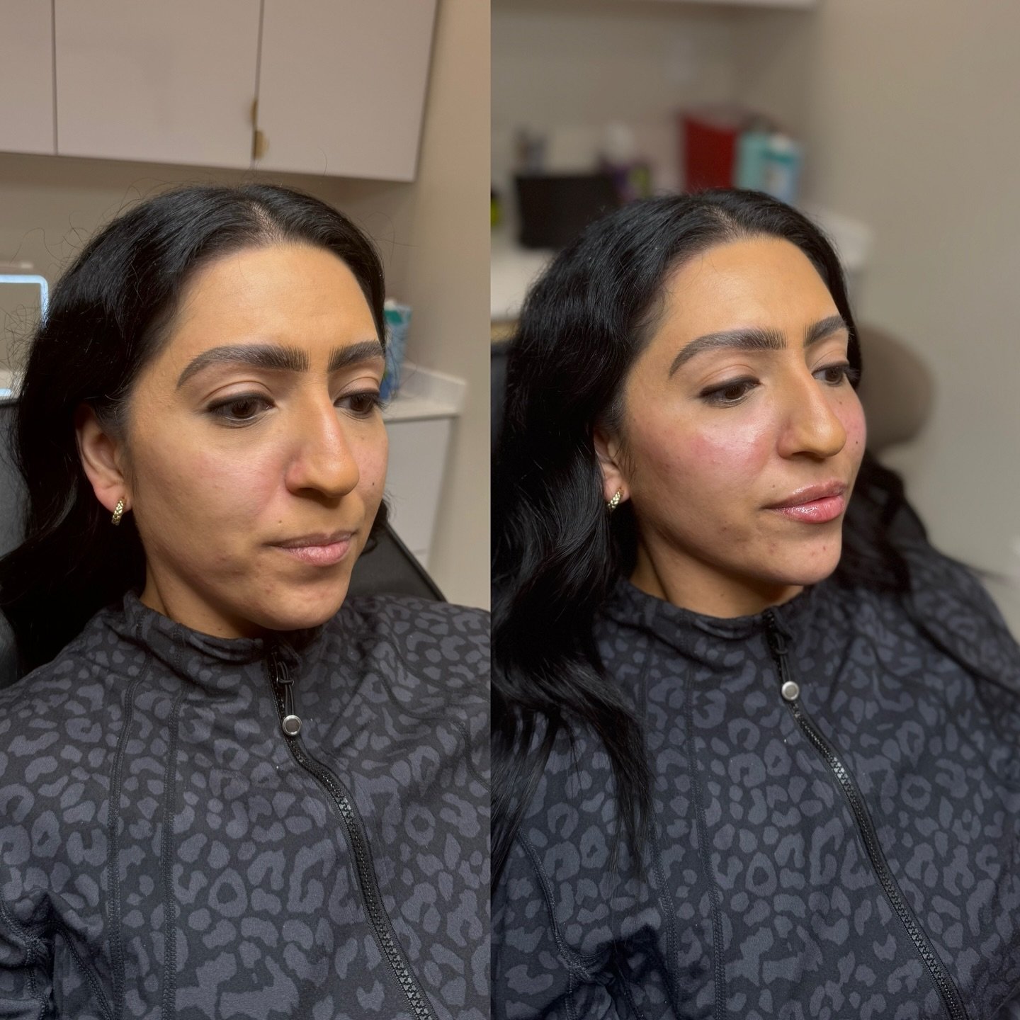 Mini Profile Balance 💉
Structure + Support + Balance + Contour 

📍Dallas &amp; Grapevine: link in bio to book 

#facebalancedallas #dallasmedspa #grapevinemedspa #dallaschinfiller #dallaslipfillers