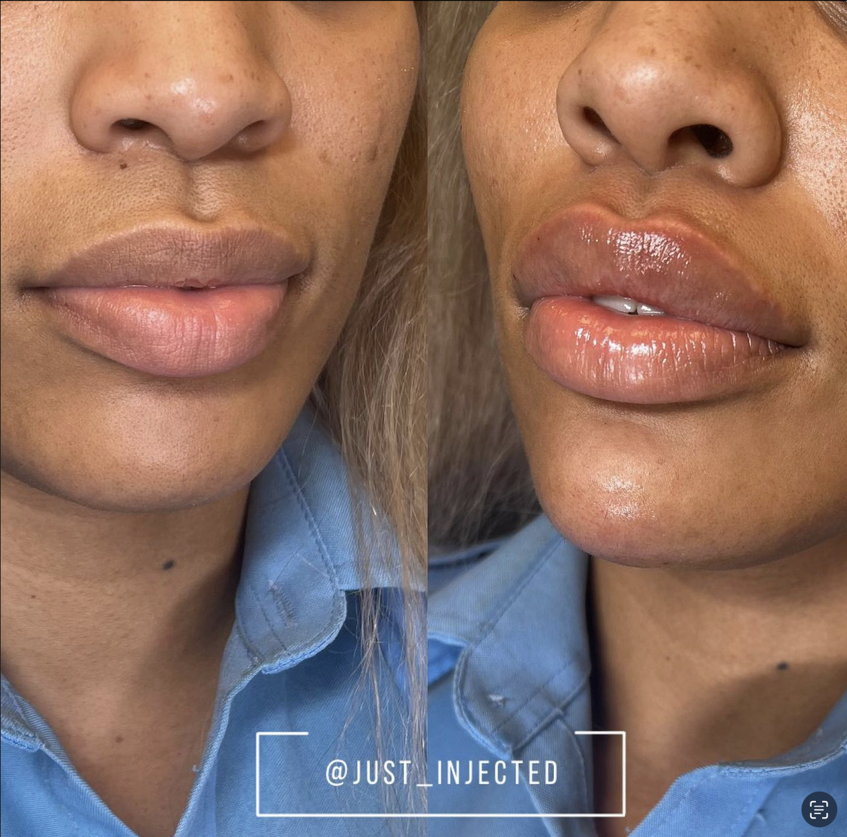 Lip filler before and after Dallas — natural volume enhancement by Justine Lewis APRN at Just Injected