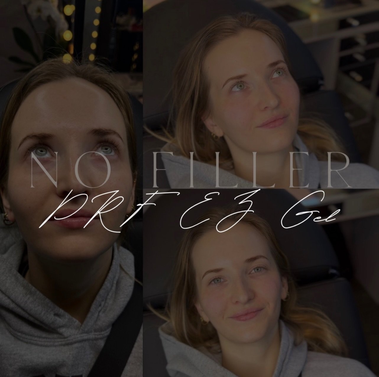 It&rsquo;s the simple things that make the biggest difference 🤩
Who doesn&rsquo;t love the most natural results with PRF Gel!
Areas treated:
&bull;Under Eyes
&bull;Nasolabial Folds 

📍Dallas &amp; Grapevine - link in bio to booking 

#prfgeldallas 