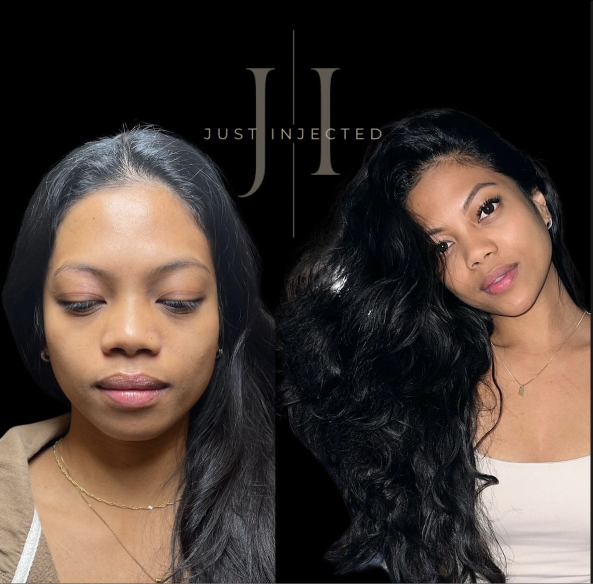 Facial balancing before and after Dallas — full-face proportion treatment by Justine Lewis APRN