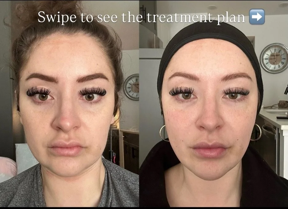 When you commit to full face treatments, you will get full face balance  results 💉
Who else loves a natural full face result?!

#dallasfacebalancing #dallaschinfiller #dallassculptra #justinjected #dallasprf