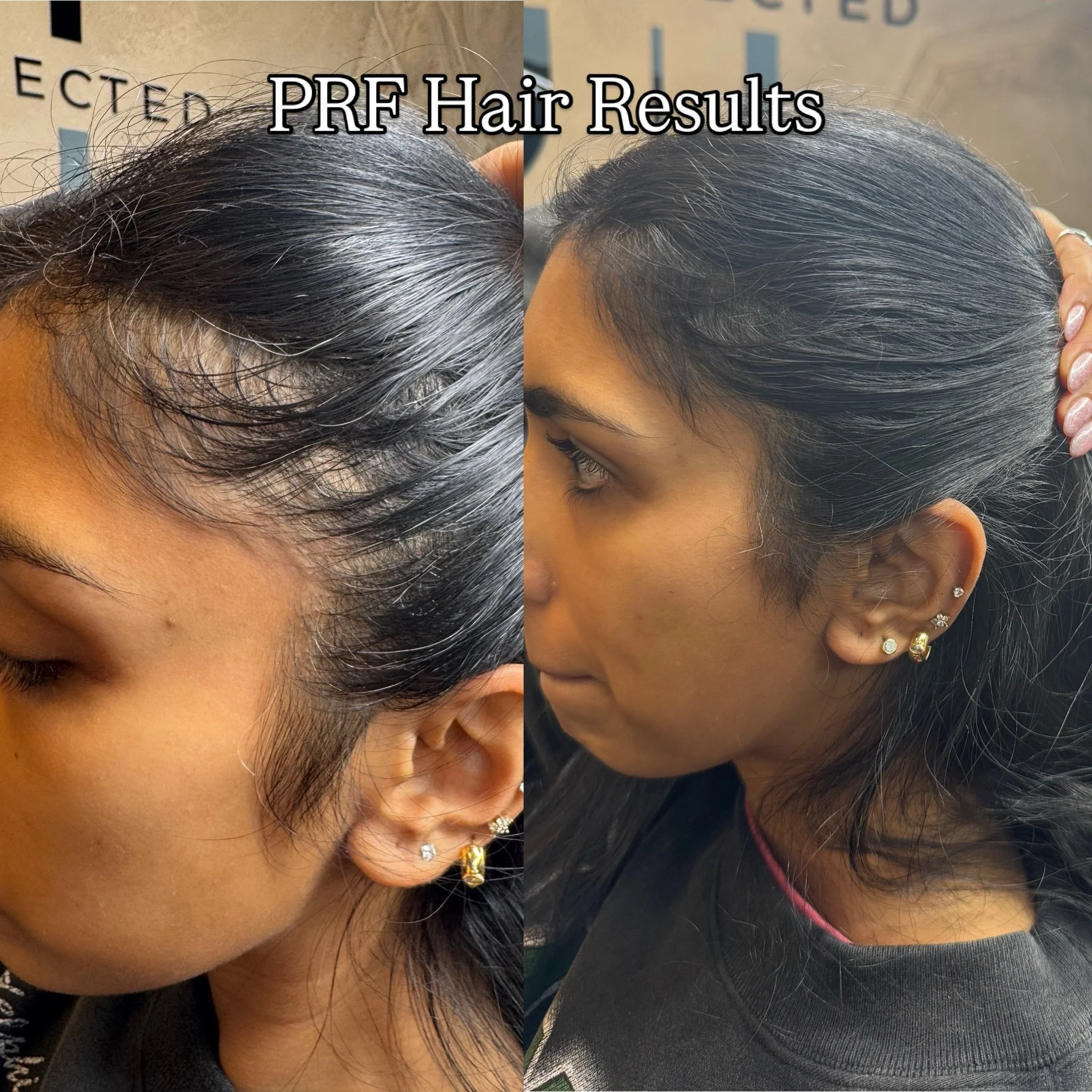 One of the best treatments for thinning/shedding/patchy hair! If you&rsquo;re an appropriate candidate, PRF for your hair is AMAZING✨

📍Just Injected - Dallas, TX
📍Just Wellness - Grapevine, TX

#prfhairrestoration #prfhairtreatment #prfdallas #dal