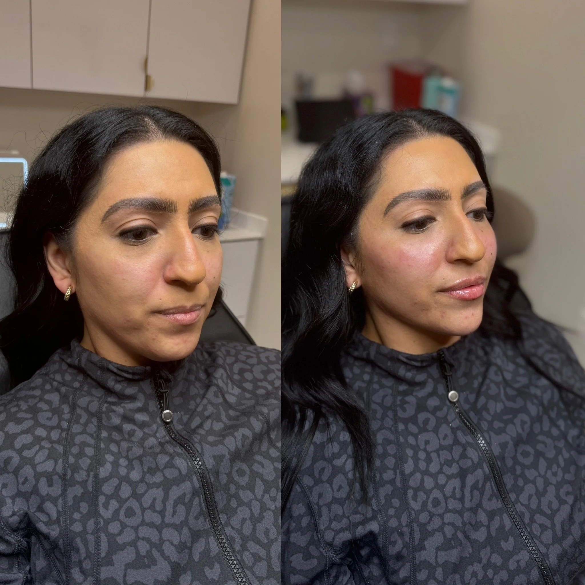 Cheek volumizing filler Dallas showing lifted mid-face results
