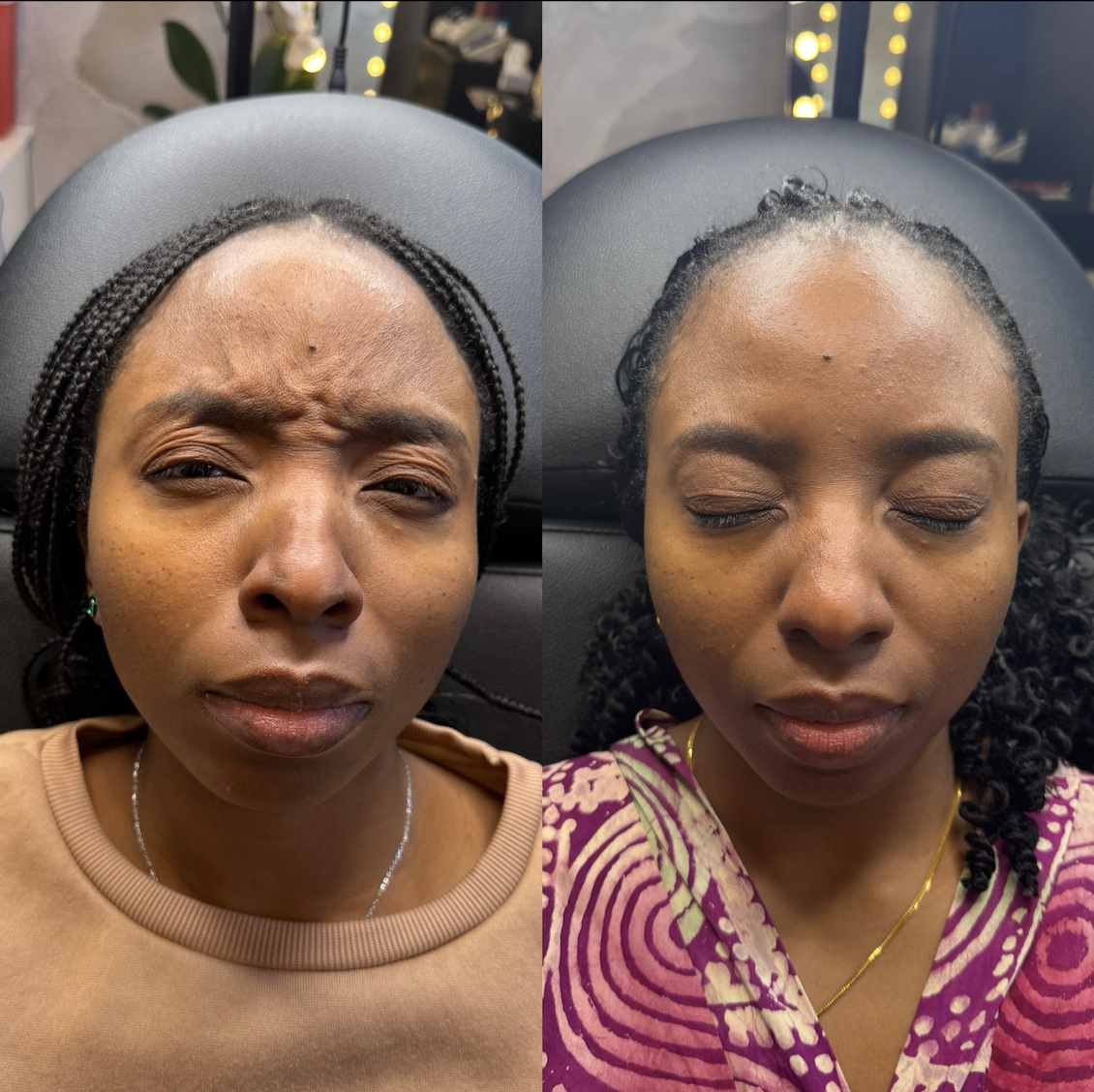 Botox before and after Dallas — forehead lines and crow's feet treatment at Just Injected