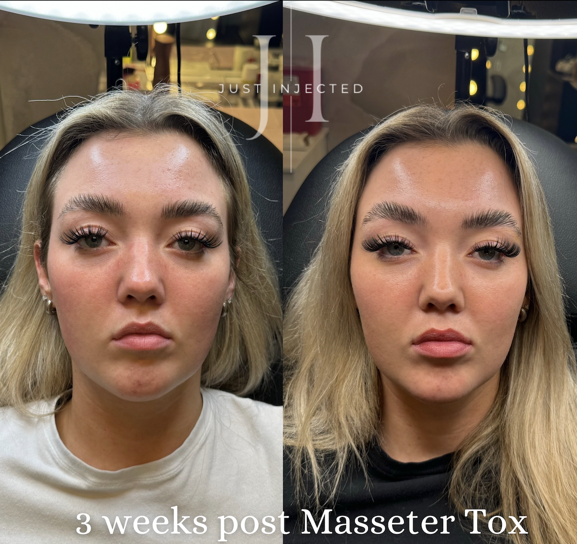 Masseter Dysport in Dallas