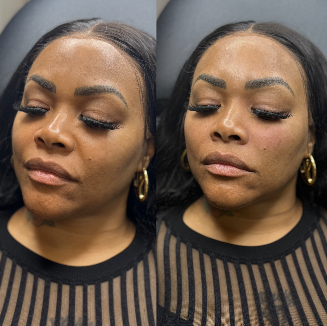 Cheek filler before and after Dallas showing lifted mid-face by Just Injected