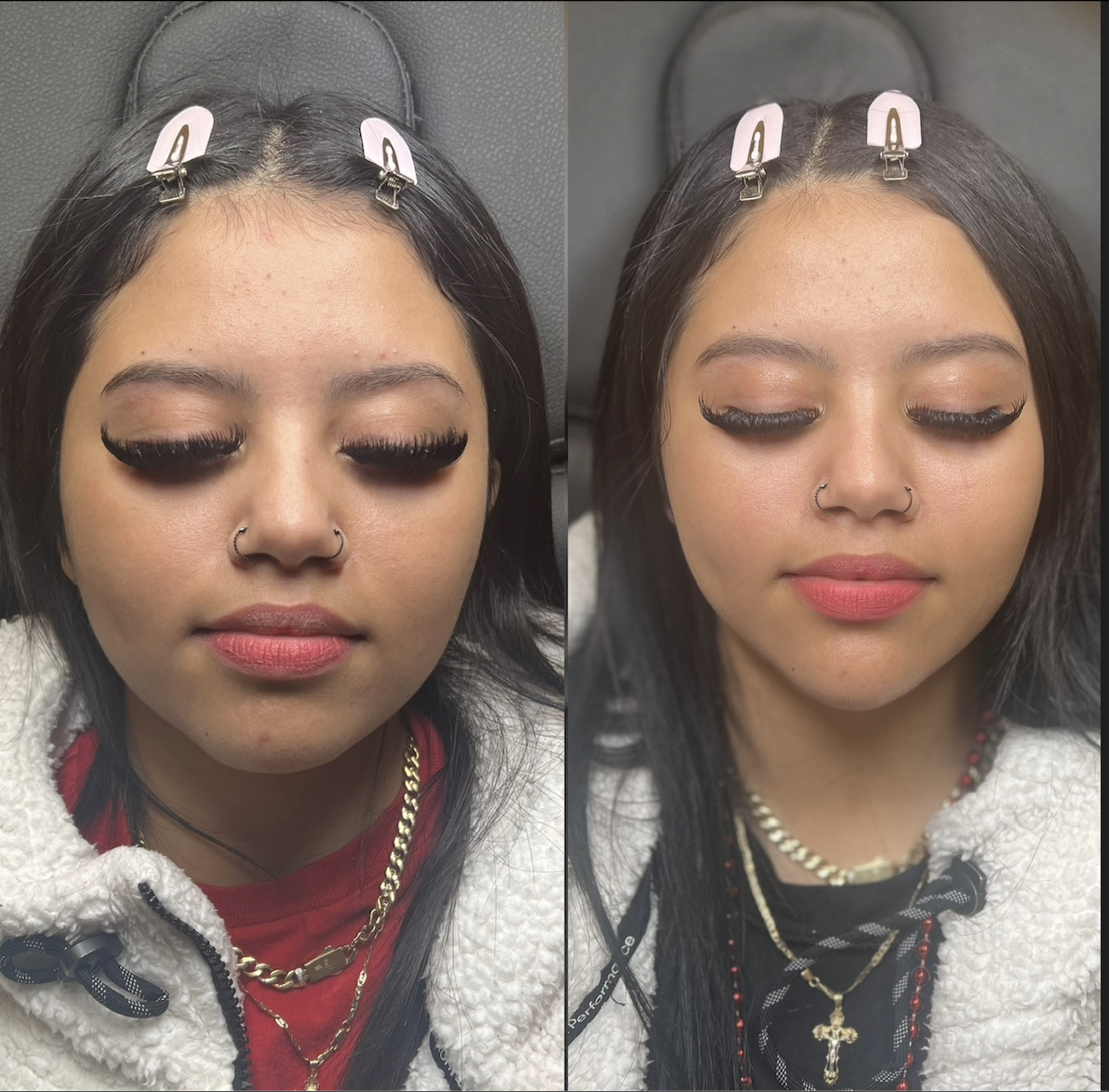 Best facial balancing Dallas showing lower face definition with chin and jawline filler creating balanced facial structure by Just Injected