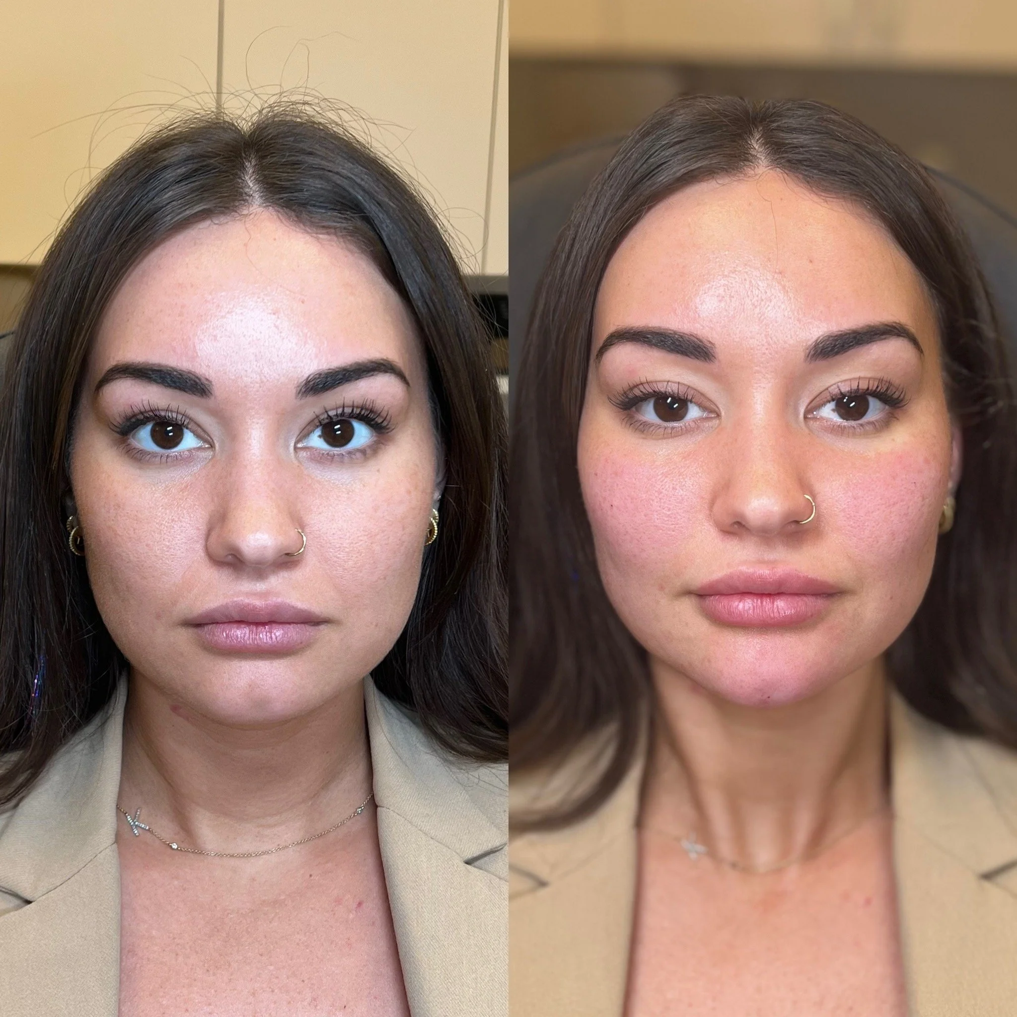 Cheek filler results Dallas — Restylane Contour natural enhancement at Just Injected Medical Spa.