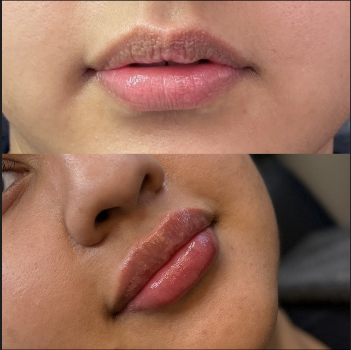 Lip injections Dallas before and after using Galderma products