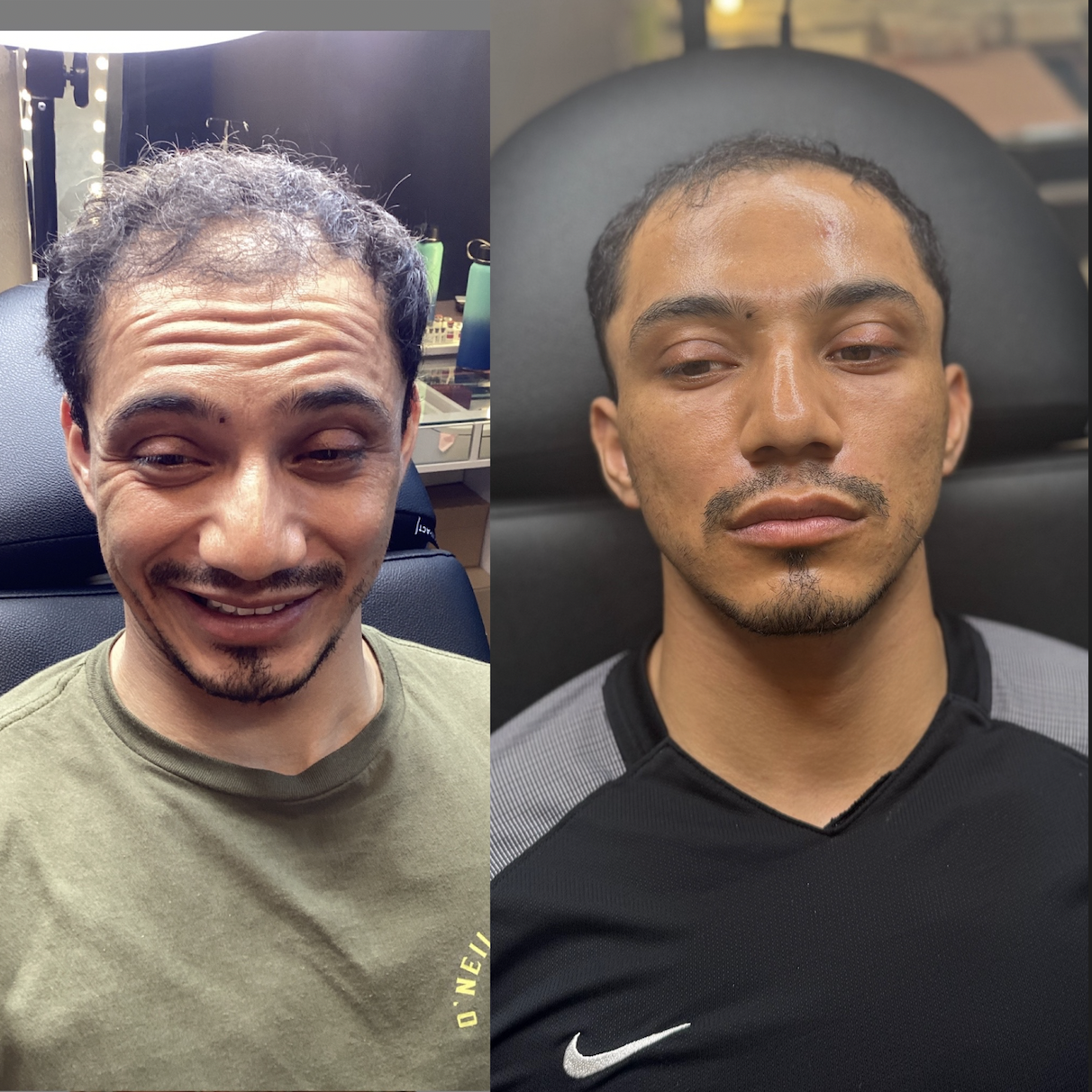 PRF EZ Gel before and after Dallas — natural growth factor filler by Just Injected Medical Spa