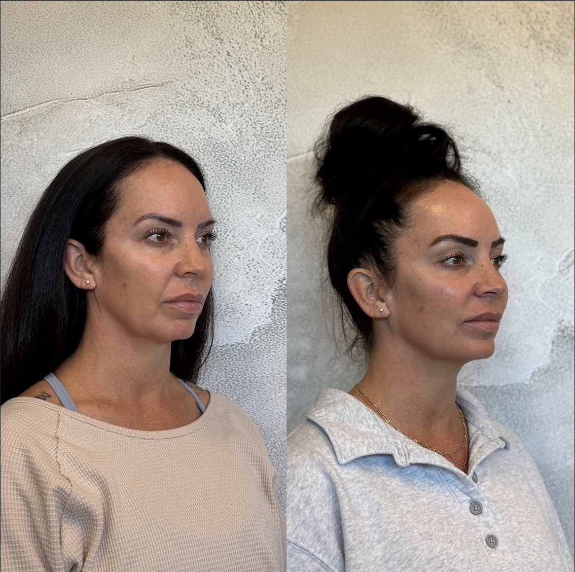 Jawline filler Dallas before and after showing sharp jaw-to-neck definition with Restylane Defyne by board-certified NP Justine Lewis at Just Injected