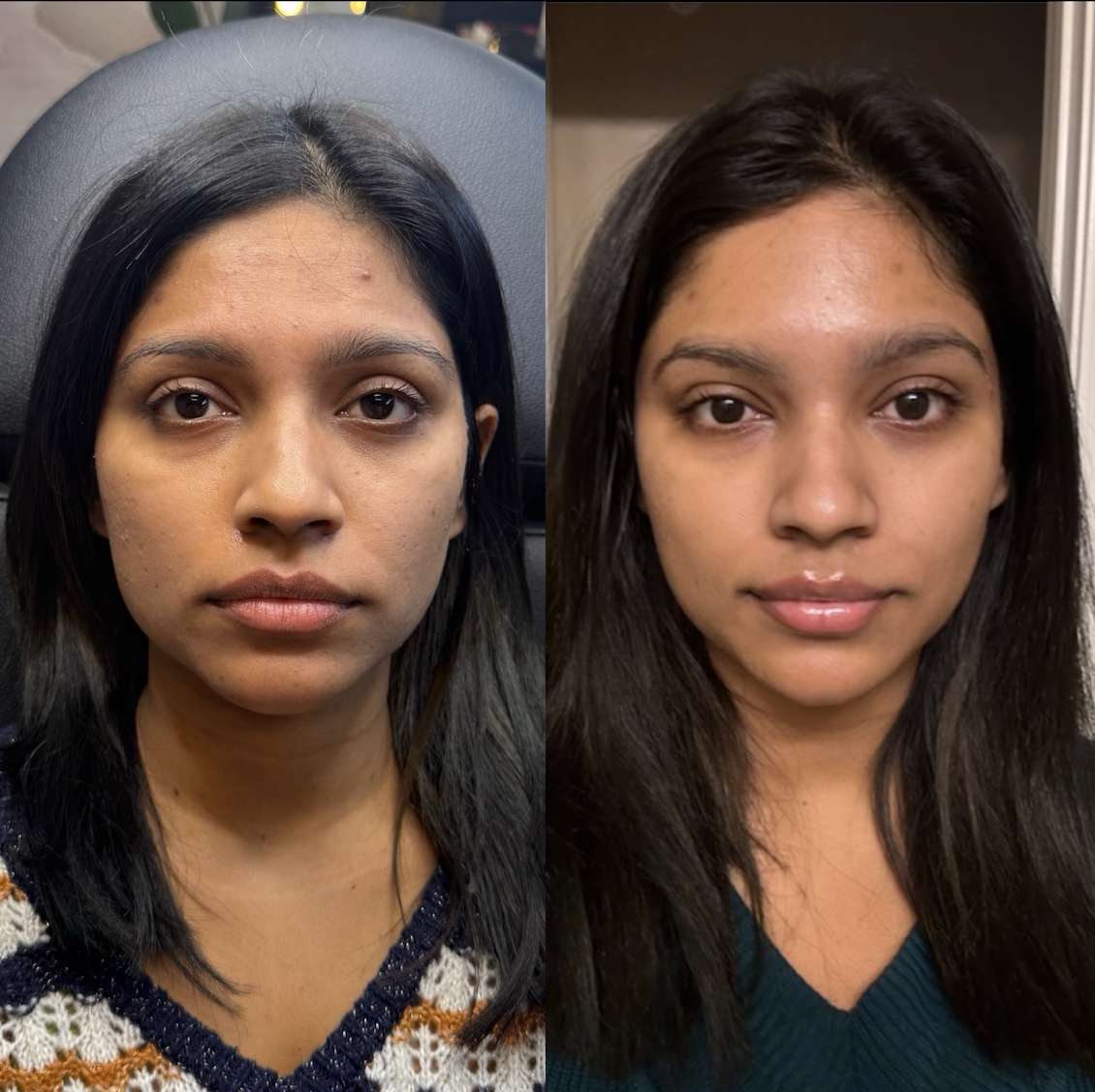 Best chin fillers in Dallas