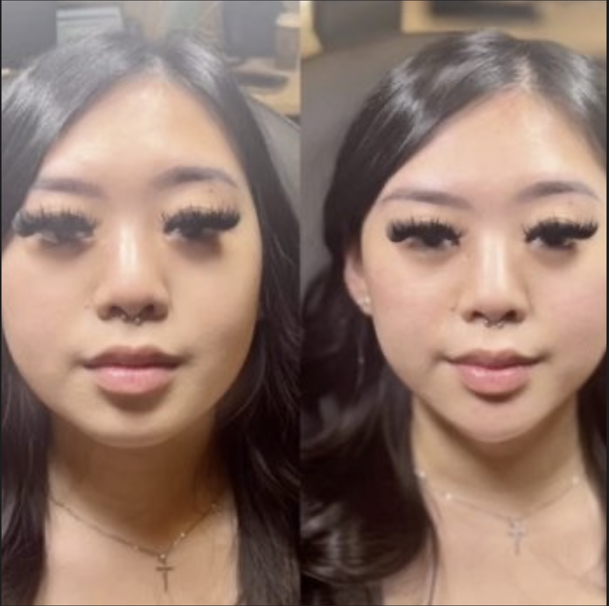 Facial balancing results Dallas — lip chin and cheek filler combination at Just Injected