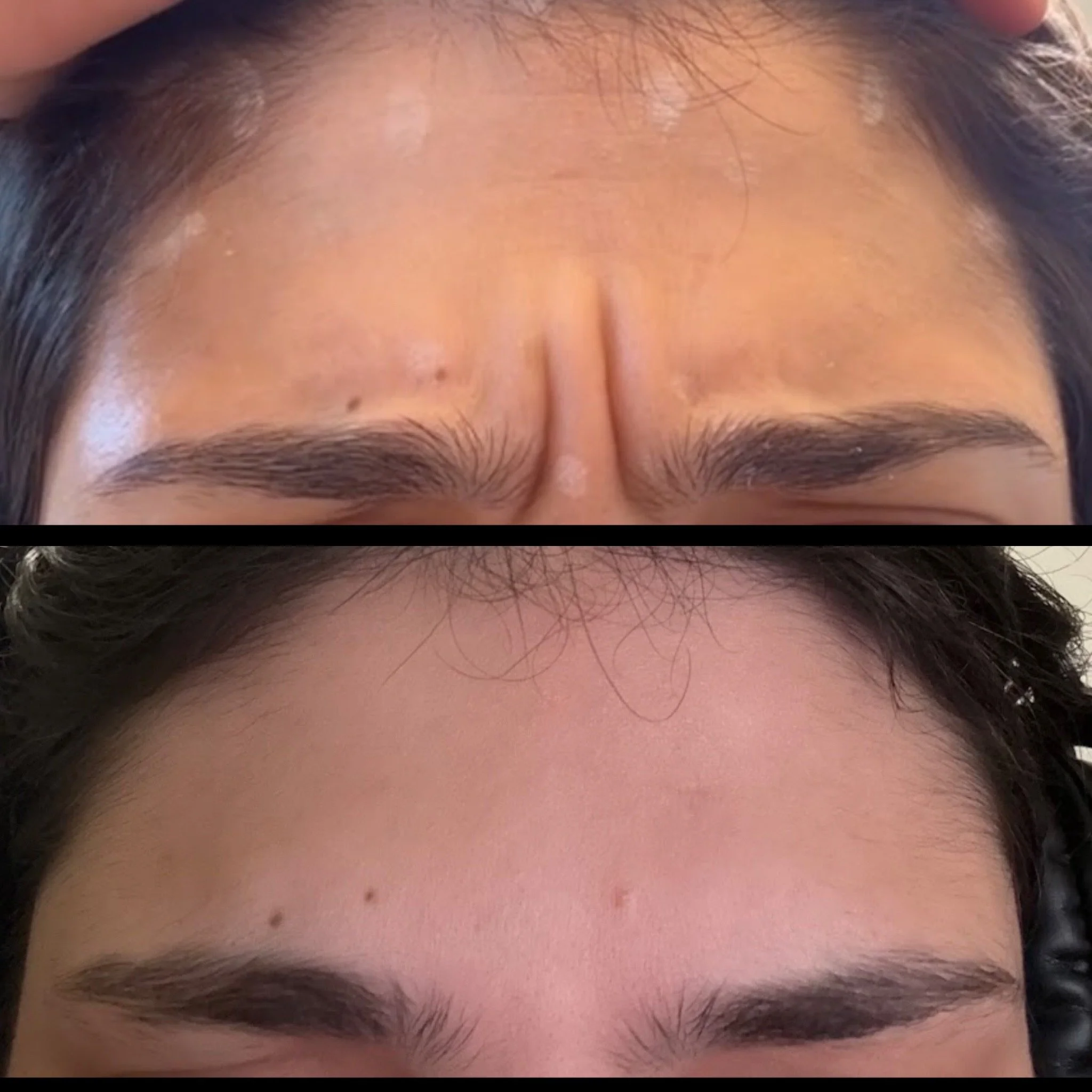 Dysport for 11s in Dallas