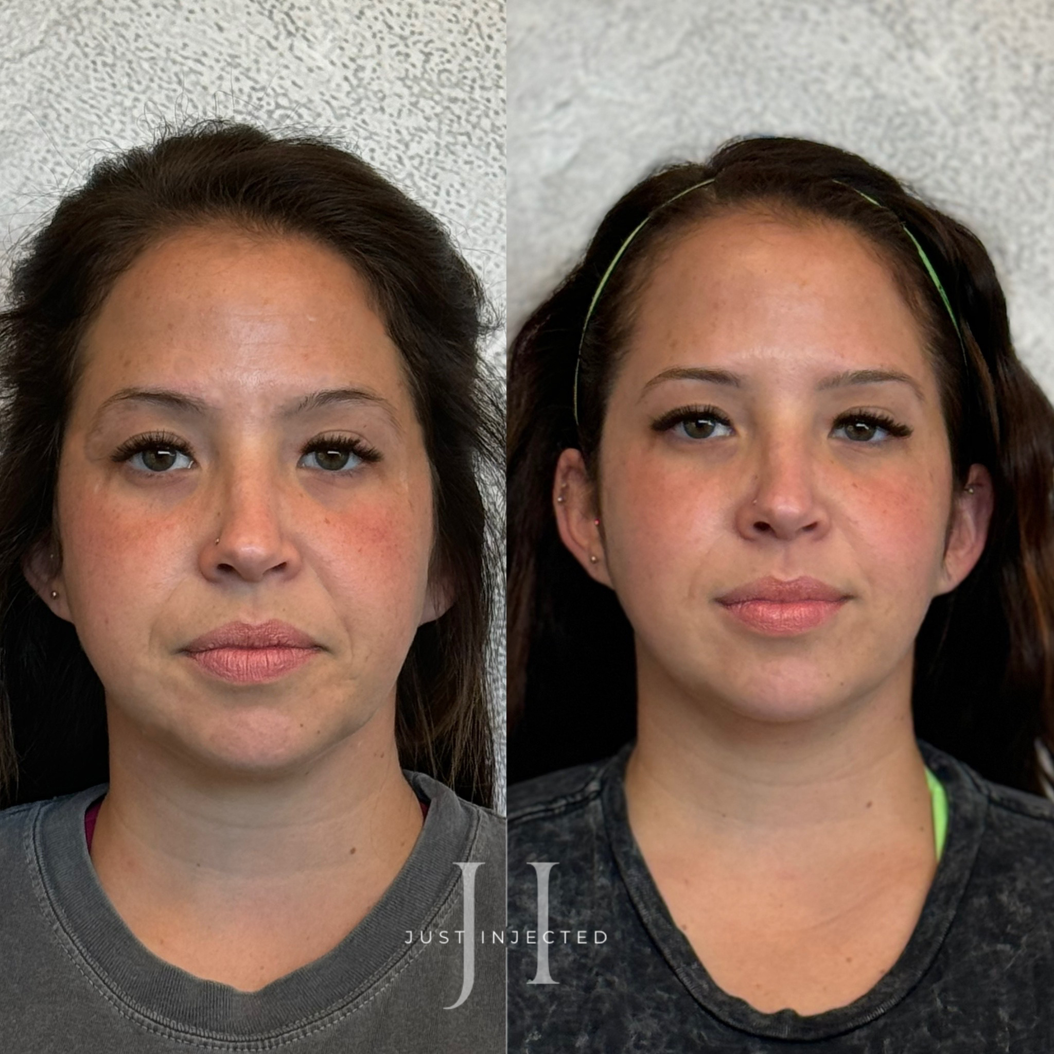 Facial balancing near me Dallas showing facial symmetry correction with strategic Galderma filler placement by board-certified NP