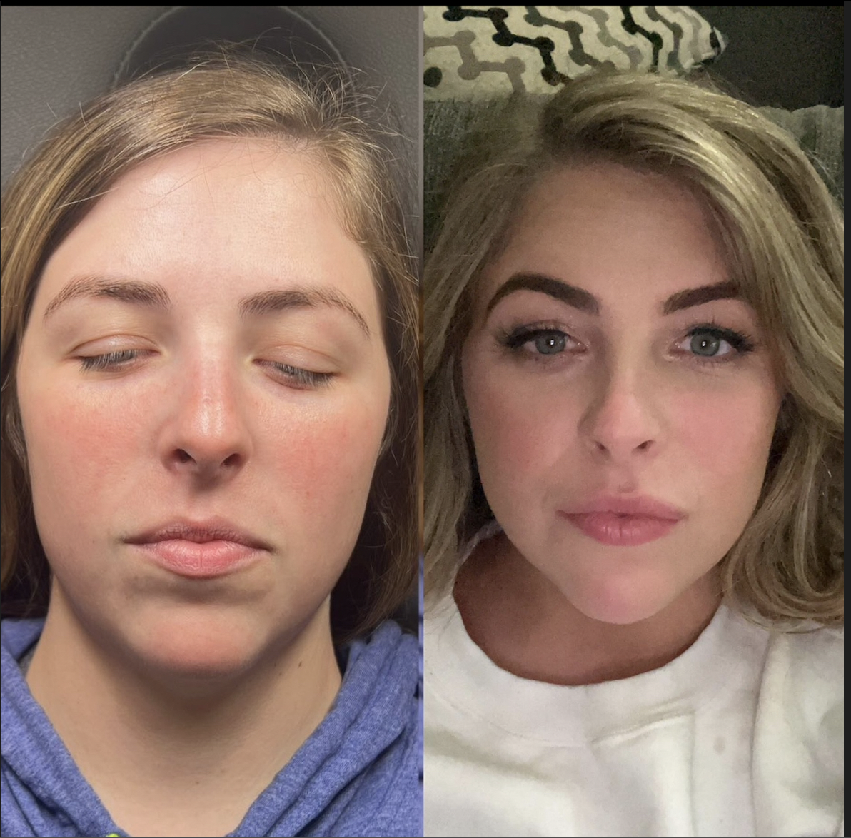 Dermal fillers facial balancing results Dallas — lip chin and cheek filler combination at Just Injected