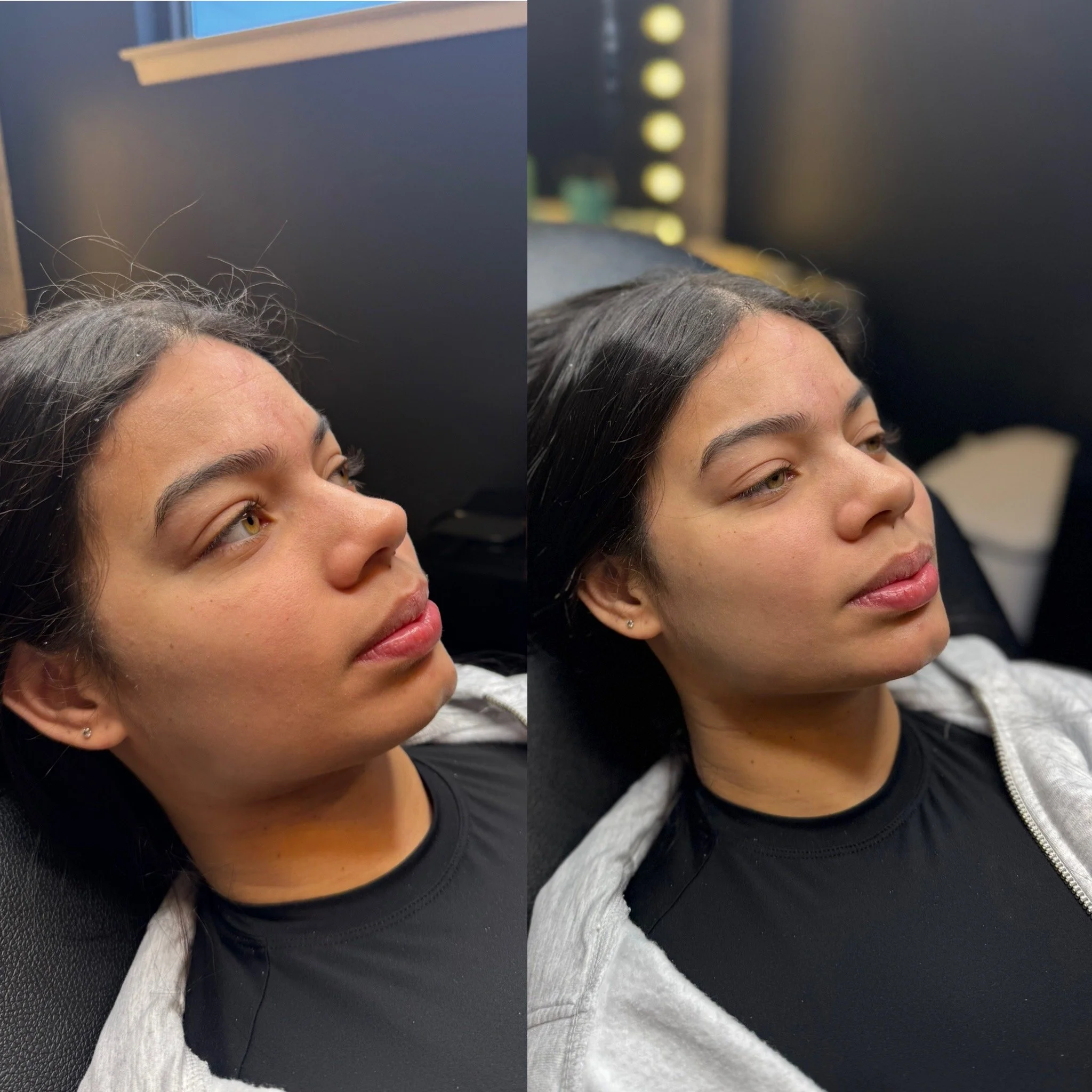 Natural chin filler results in Dallas