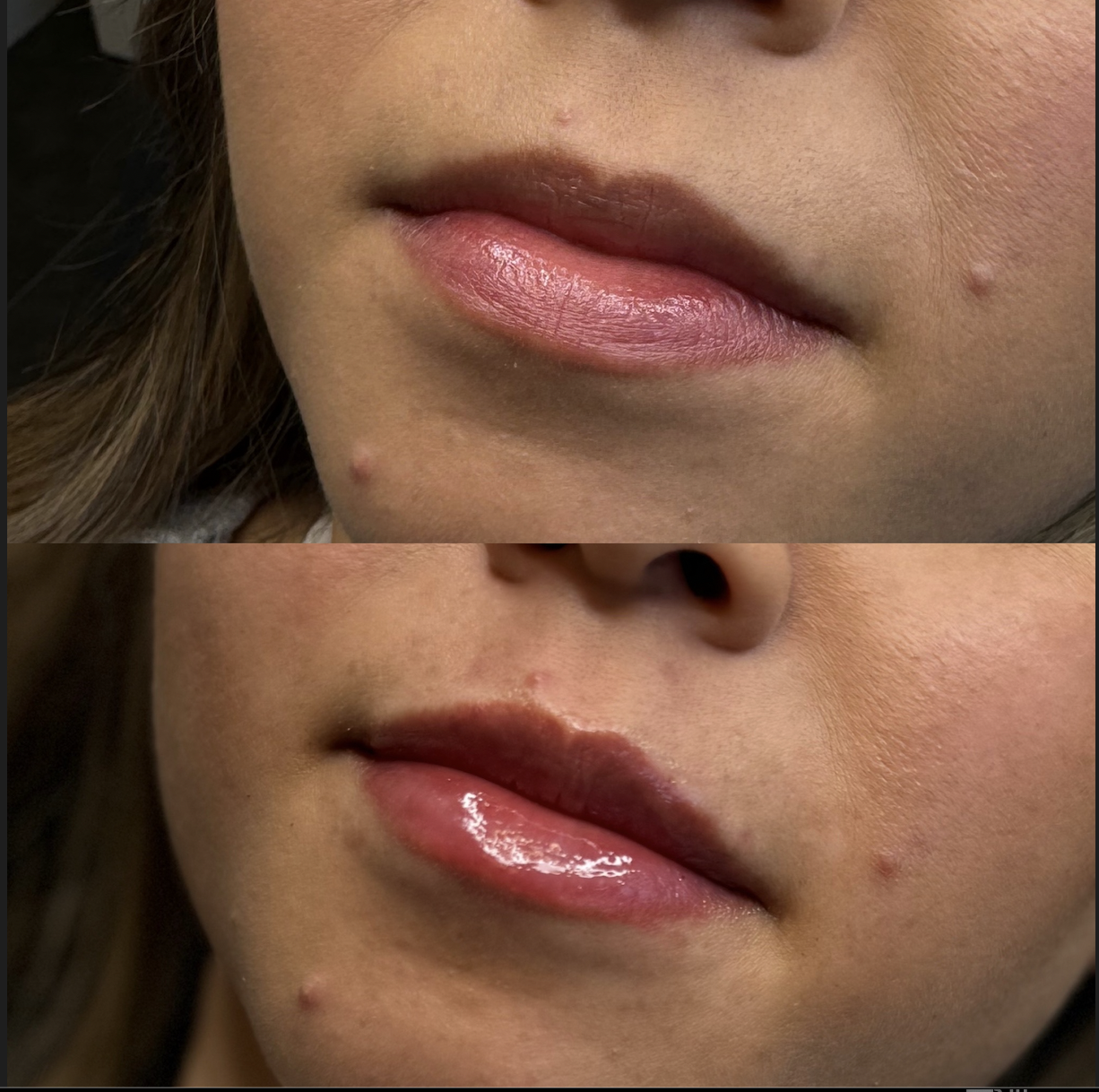 Best lip filler in Dallas