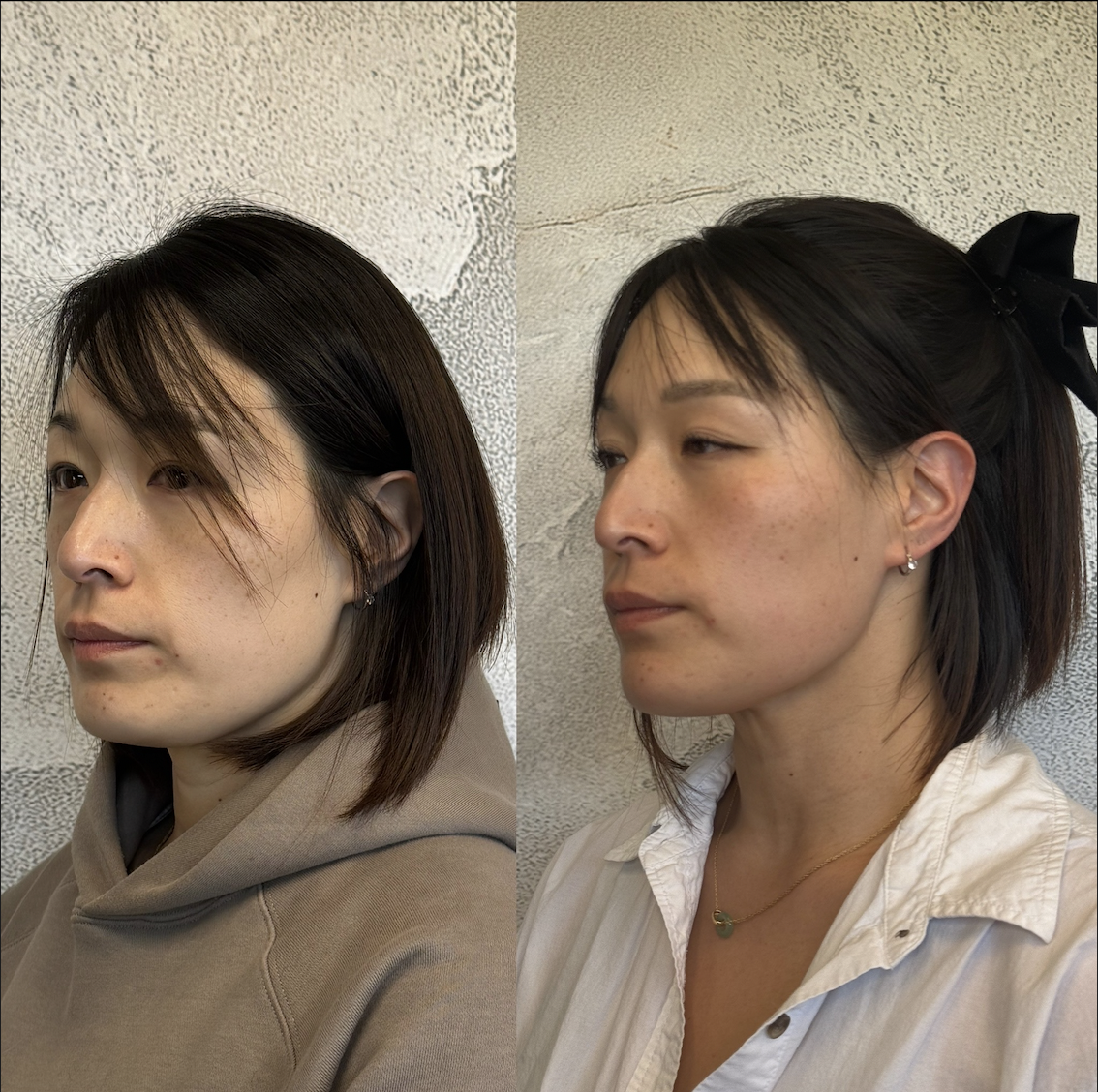 Jaw filler Dallas showing masculine jawline contour and angular profile created with Restylane Defyne at Just Injected med spa