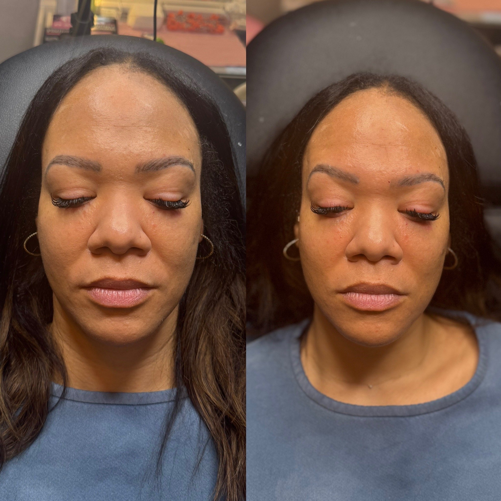 Natural chin filler results in Dallas