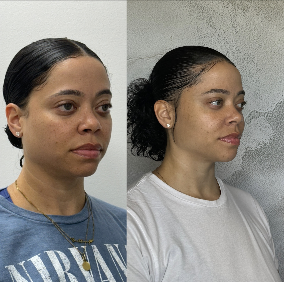 Jawline contouring Dallas before and after demonstrating enhanced lower face structure and mandibular definition with dermal filler